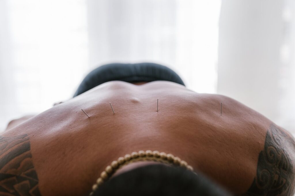 Close-up image of acupuncture needles applied to a person's back during treatment, how dry needling differs from acupuncture